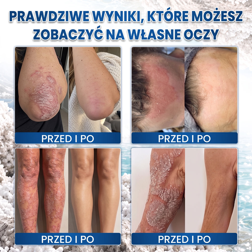 💧 Medistart® Specjalistyczny krem do pielęgnacji skóry z łuszczycą – ✅ Testowany dermatologicznie