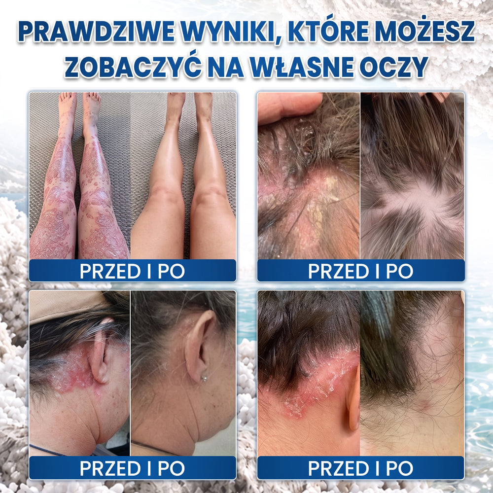 💧 Medistart® Specjalistyczny krem do pielęgnacji skóry z łuszczycą – ✅ Testowany dermatologicznie
