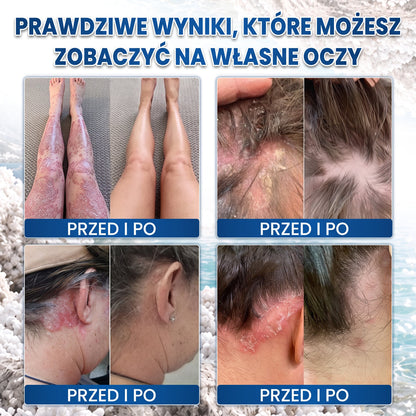 💧 Medistart® Specjalistyczny krem do pielęgnacji skóry z łuszczycą – ✅ Testowany dermatologicznie
