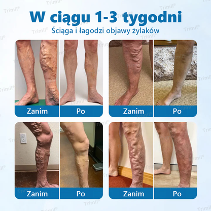 💙Trimil® Ziołowy Spray na Ochronę Żył - ✅ Klinicznie udowodniono, że eliminuje żylaki w zaledwie 7 dni!