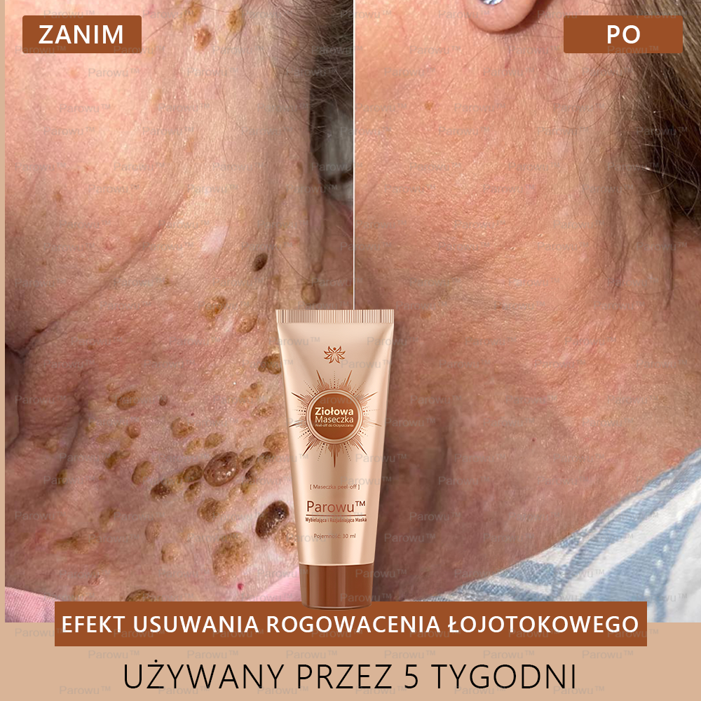 🌷Parowu™ Wybielająca i Rozjaśniająca Maska - Naturalne składniki trwale usuwają plamy, piegi i przebarwienia