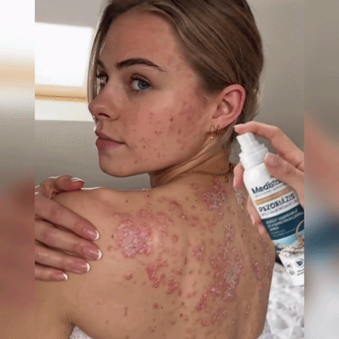 💧 Medistart® Specjalistyczny krem do pielęgnacji skóry z łuszczycą – ✅ Testowany dermatologicznie