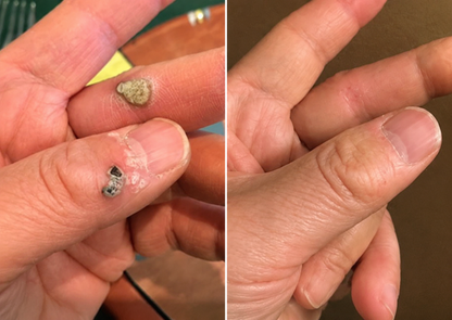 ✨PuraCure® 2-w-1 plaster mikroigłowy i hydrokoloidowy🍀 | Usuwa wypukłe znamiona, trądzik, płaskie brodawki i brodawki skórne | Pomaga poprawić zmarszczki, blizny i niedoskonałości | Niewidoczne plastry na twarz i ciało